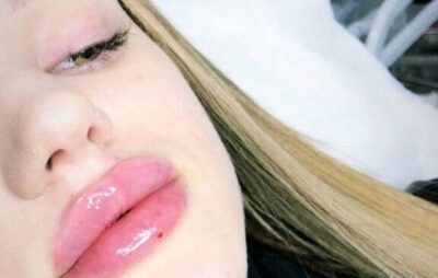 Скандальна франківська блогерка Верба зробила собі контурну пластику губ. Фото: Юля Верба