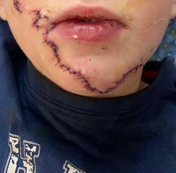 10-річний хлопчик з Львівщини отримав важку травму обличчя